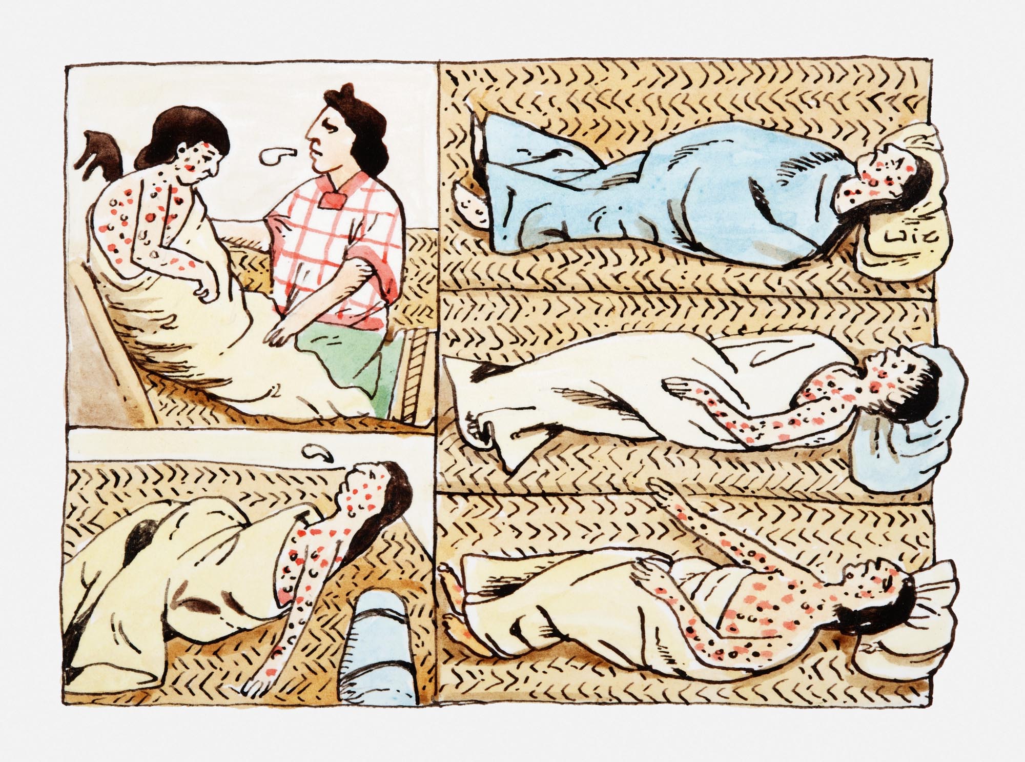 An illustration depicting individuals suffering from smallpox, showing people with visible rashes and lesions on their skin, some lying down and others being attended to.