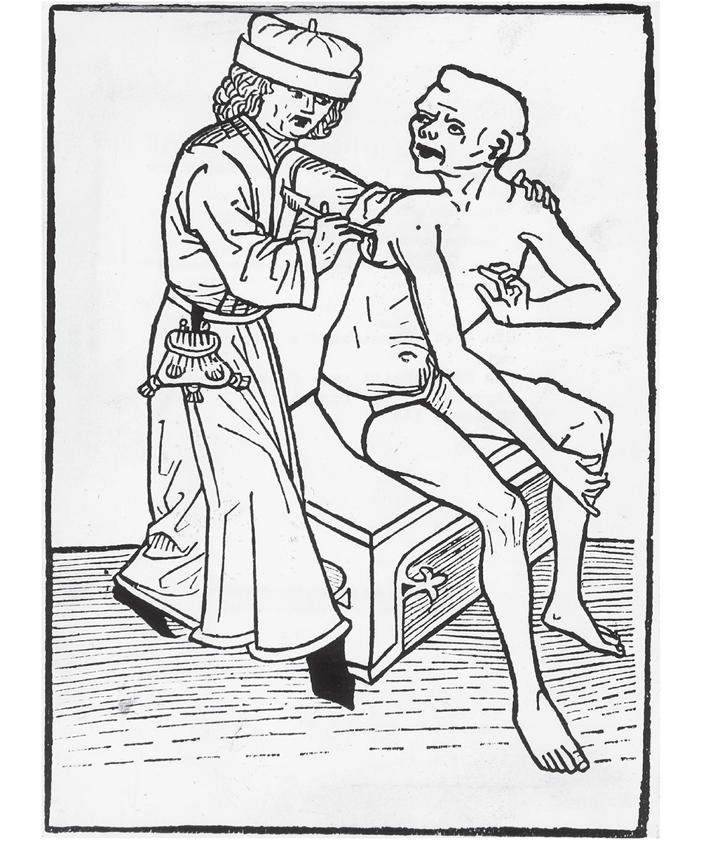 Woodblock print of a medieval doctor in long robes performing surgery on a plague victim.