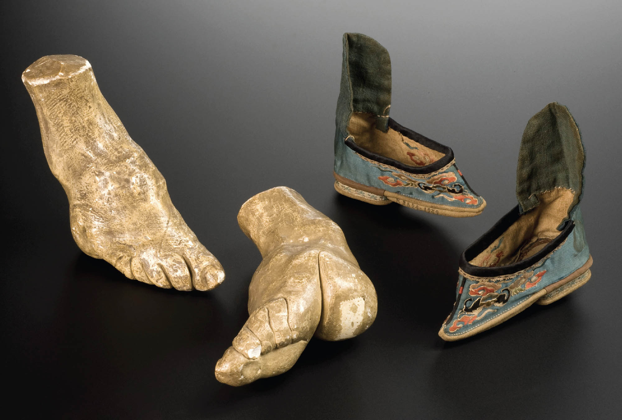 Photo of two very small, embroidered shoes, and models of feet that were bound to fit into such shoes. The toes are curved inward, and the ball of the foot and heel are bent toward each other.